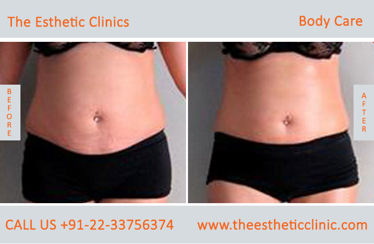 body care laser treatment before after photos in mumbai india (4)